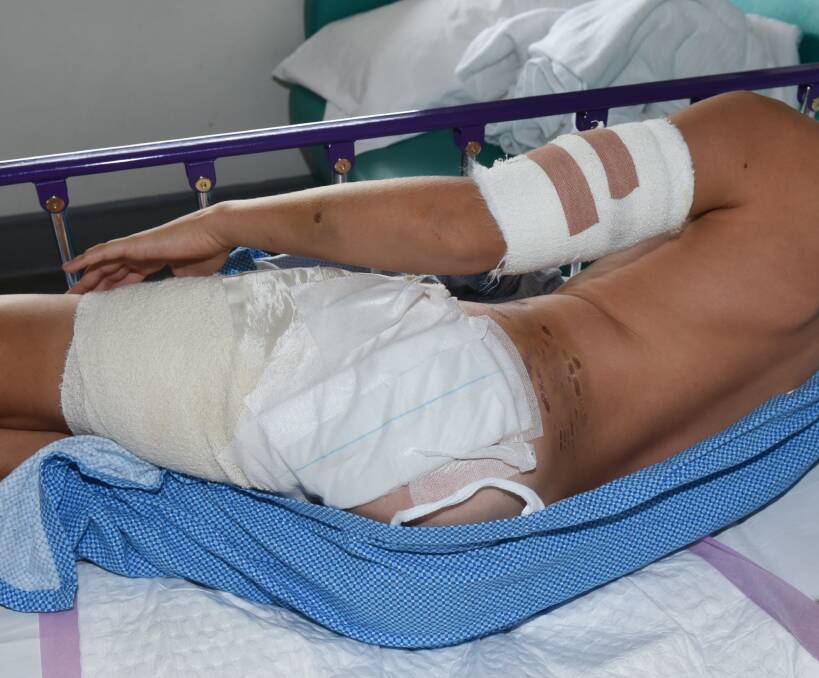 INJURIES: Marcus Geary, 11, has undergone two surgeries since he was attacked by a German Shepherd at Wynyard on Saturday. He is recovering at the Launceston General Hospital. Picture: Neil Richardson