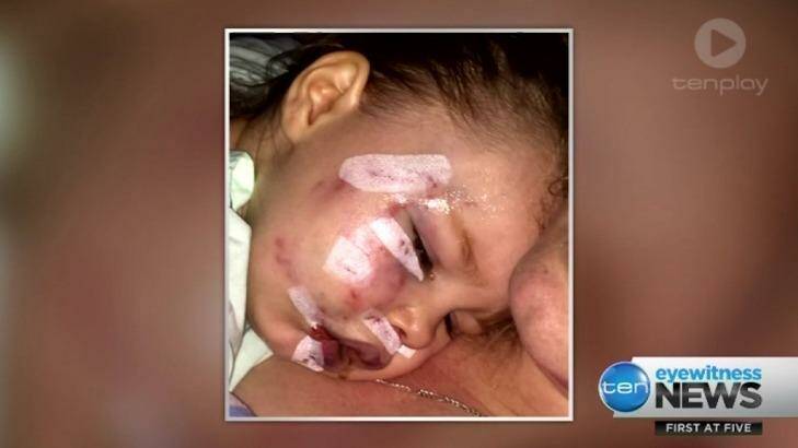 The Perth toddler required plastic surgery and nearly 50 stitches Photo: Ten News