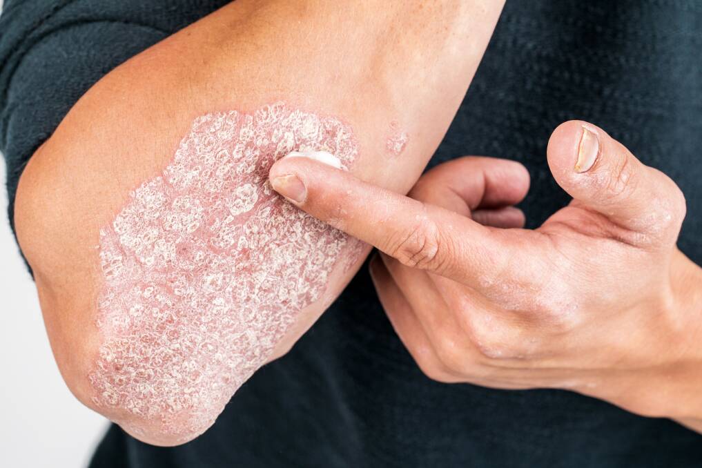 Psoriasis is a chronic inflammatory skin disease that can severely affect the quality of life of those suffering with the condition. Picture: Shutterstock.